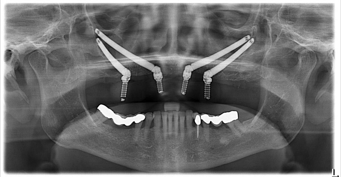 Zygomatic Dental Implants: A Solution for Patients with Severe Bone Loss