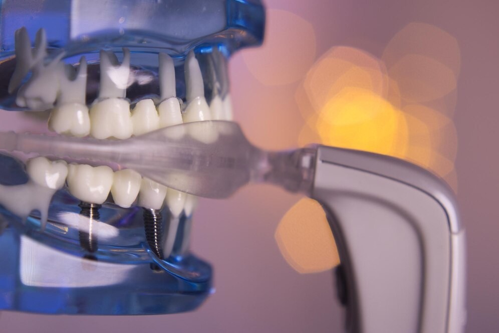 How Dental Implants Are Revolutionizing Modern Dentistry