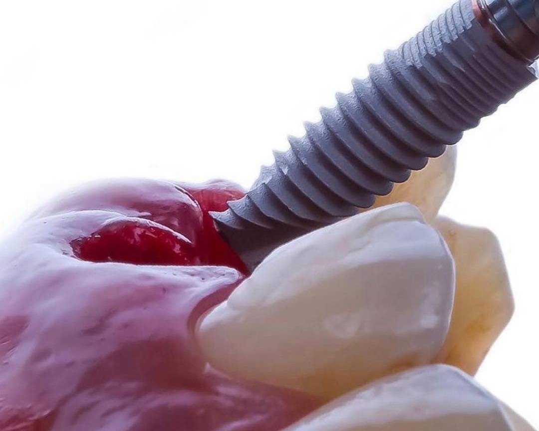 Root Canal Treatment: An Ultimate Tooth-Saving Solution