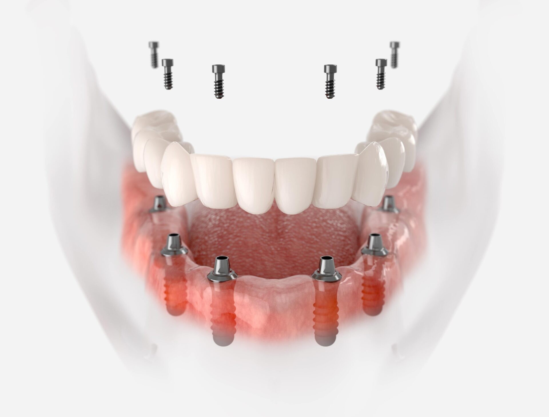 Rebuilding Your Smile Naturally with Full Arch Restoration