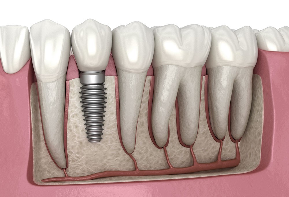 Restore Your Smile and Confidence with Full Mouth Dental Implants