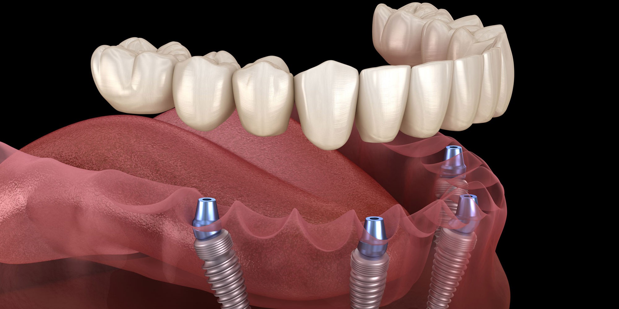 Transform Your Smile and Confidence with Full Mouth Dental Implants